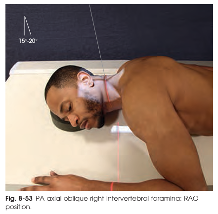 <p>This projection clearly demonstrates the intervertebral foramina (IVF) and pedicles of the cervical spine, focusing on those closest to the image receptor (IR). Both RAO (right anterior oblique) and LAO (left anterior oblique) positions are used for full assessment.</p>