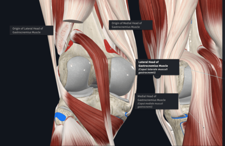 <p>Origin: Gastrocnemius</p>