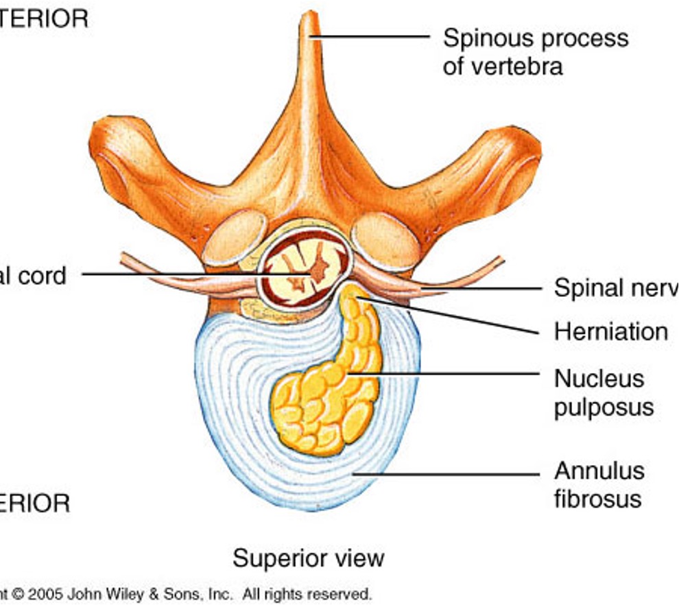 <p>intervertebral disc prolapse</p>