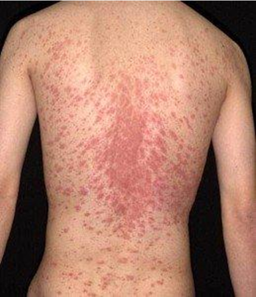 <p>Pityriasis Rosea </p>