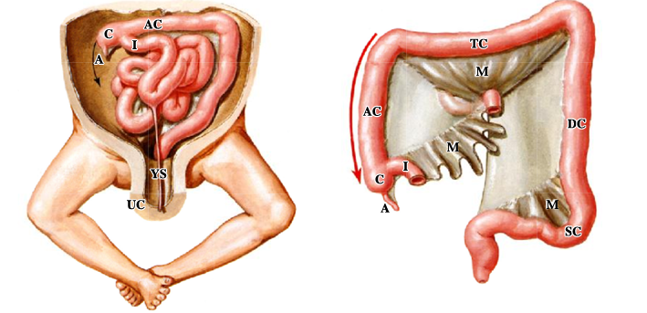 <p>-improper rotation can result in volvulus (twisting) that can cause obstruction as well as a compromised blood supply resulting in ischemia and subsequent necrosis</p><p>-volvulus not only a developmental problem; can occur throughout life</p>