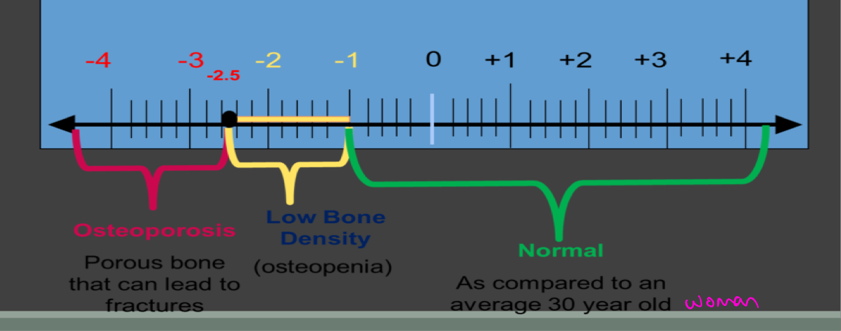 <p>Indicated patients BMD in standard deviations above or below that of mean for young adult women</p><p>For each 1 SD in T score, fracture risk nearly doubles</p><p>Osteoporosis: below -2.5</p><p>Osteopenia: between -1 and -2.5</p><p>Normal score&gt;-1</p>