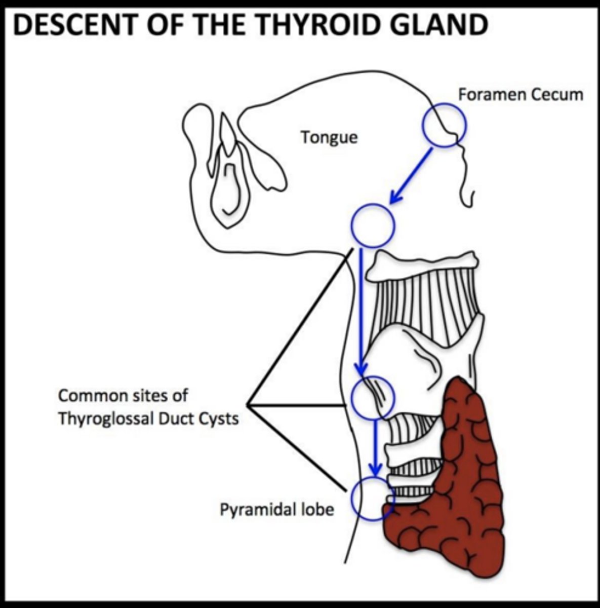 <p>Thyroid tissue along migration path (foramen cecum)</p>