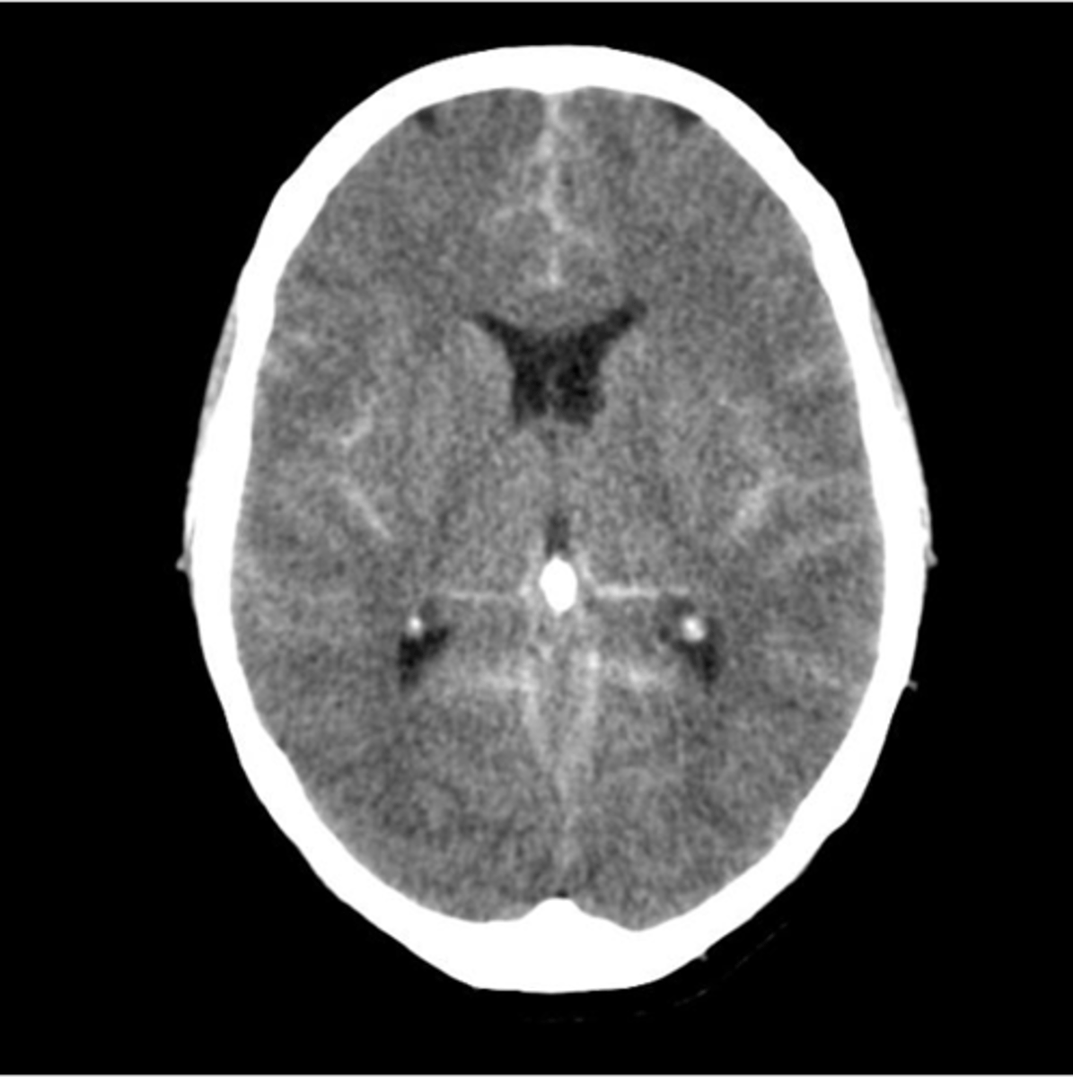 <p>more diffuse presentation</p>