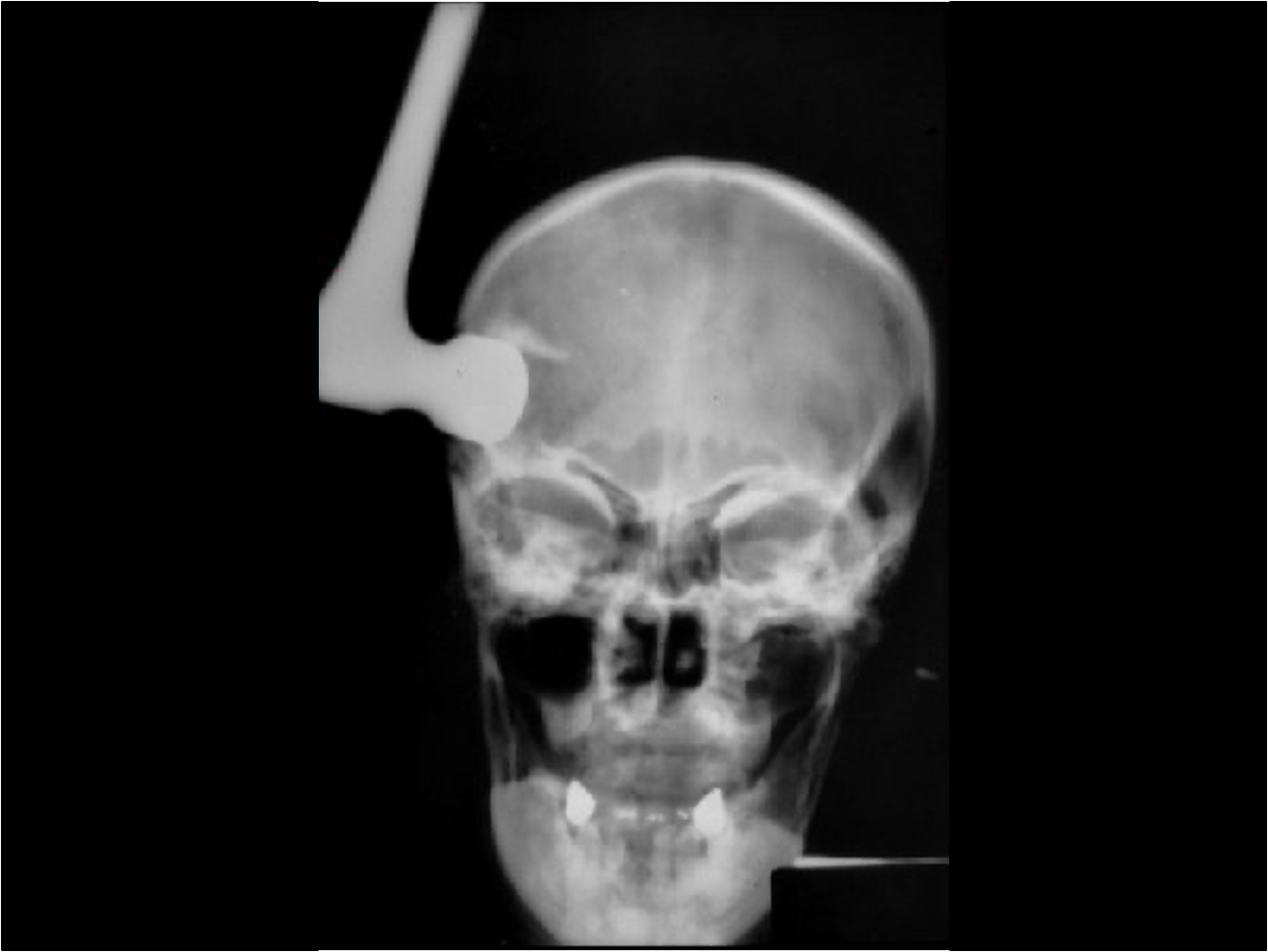 <p>Why might cerebrospinal fluid (CSF) offer little protection in cases of penetrating head trauma?</p>