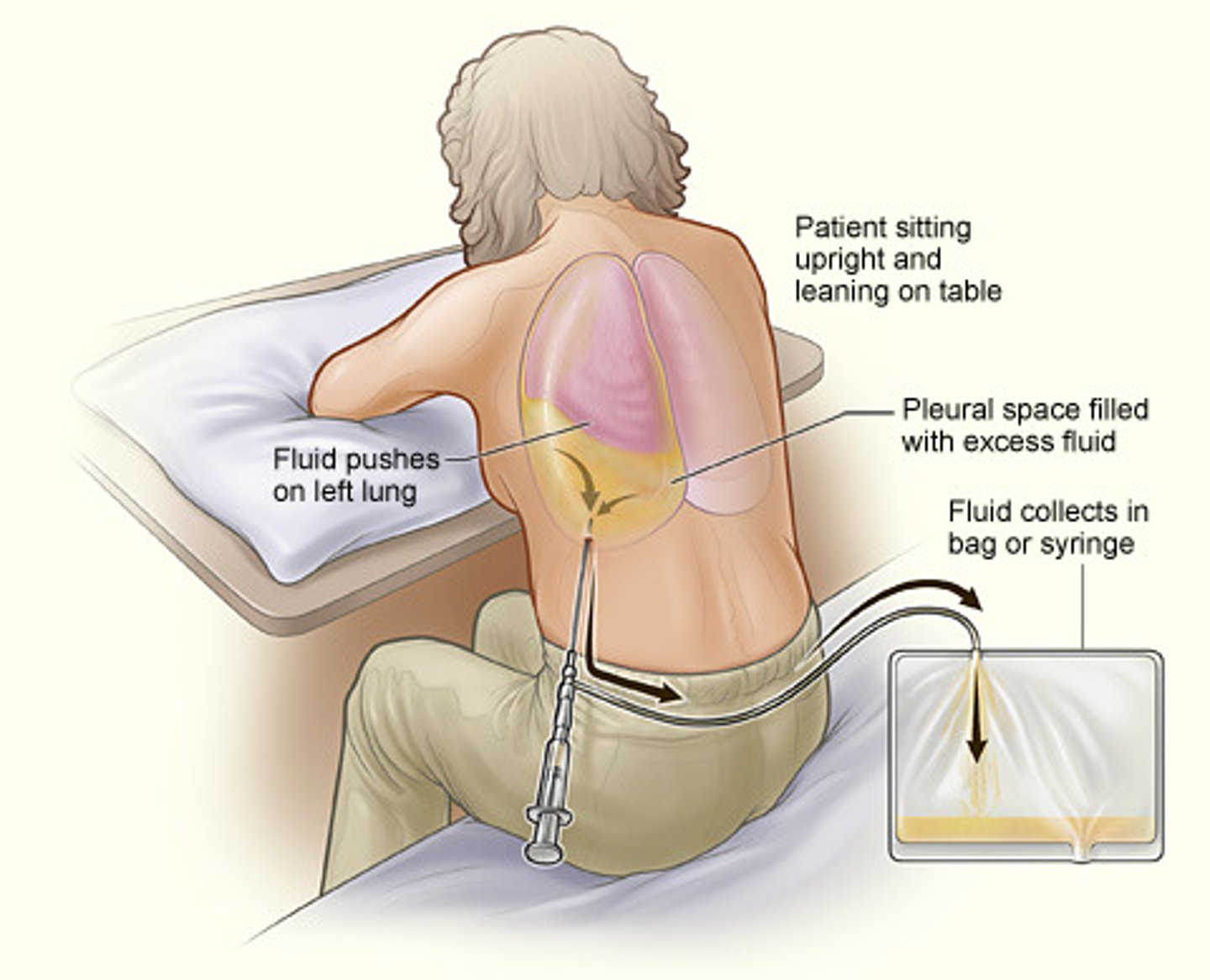 <p>-Procedure of puncturing the chest wall and aspirating pleural fluid or air from the chest</p><p>-At the bedside or under fluoroscopy if they want to really visualize</p><p>-Sterile procedure</p><p>-Patient sits on side of bed or in a chair</p><p>-Monitor VS, ABC’s</p><p>-Max amount removed <strong>is 1000 ml</strong></p>