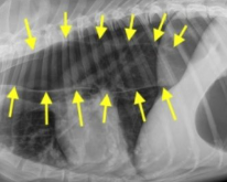 <p>What condition causes diffuse megaoesophagus and its pathophysiology and sequalae</p>