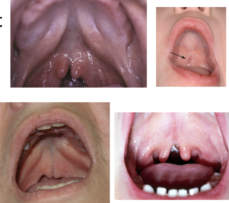 <ul><li><p><strong>Intact mucosa</strong></p></li><li><p><strong>Defect of muscles of soft palate</strong></p></li><li><p>Frequent <strong>notch in bone</strong> along posterior margin of hard palate</p></li><li><p><strong>Bluish midline</strong> discoloration</p></li><li><p>Best identified by <strong>palpation</strong> <strong>with</strong> <strong>blunt</strong> <strong>instrument</strong></p></li><li><p>Can be associated with cleft uvula</p></li></ul><p></p>