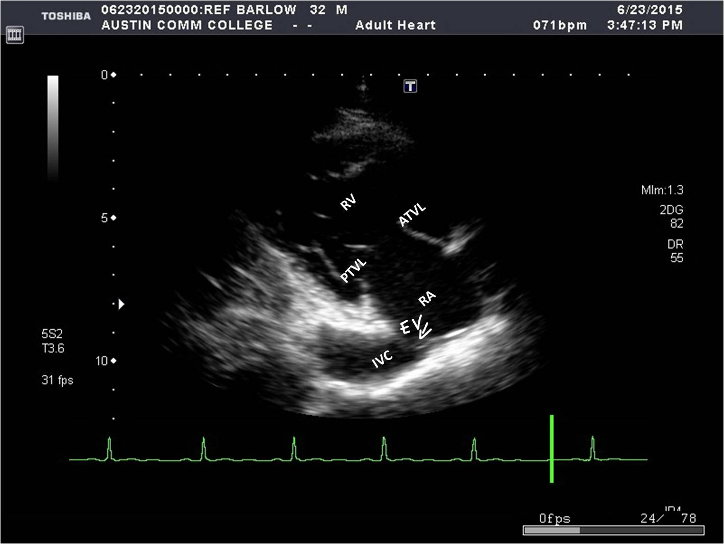 * RA
* RV
* Tricuspid valve
* Coronary sinus
* IVC
* Eustachian valve