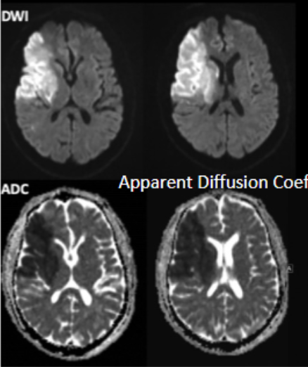 <p>Stroke where blood clot plugs up an artery<br><br>brighter/darker section of brain on MRI/CT</p>