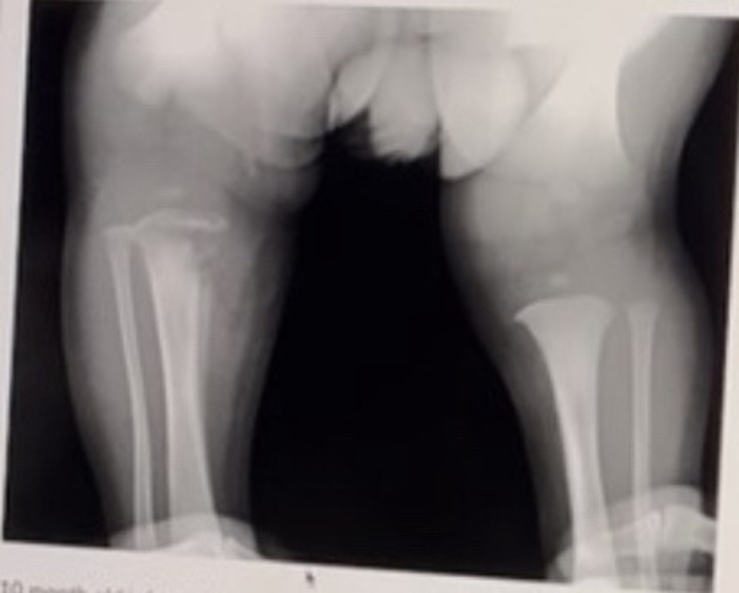 <p>10 month old infant with 1 week history of knee pain and swelling</p><p>Please choose the best management and most likely lab finding.</p><p>Select 2 correct answers</p>