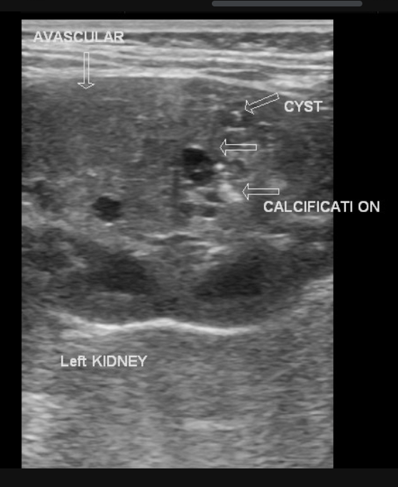 <p>5 y/o male presents to the clinic for a well child check. Parents state that they’ve recently notice a lump in his stomach when they hug him. Vitals are stable with the exception of 100.4 temp and 144/88. On physical exam you note a non-tender firm, fixed mass in the abdomen, pallor, and a varicocele. Labs reveal hematuria, polycythemia. U/S reveals an intrarenal mass that is BOTH cystic and solid. What would be a favorable biopsy result?</p>