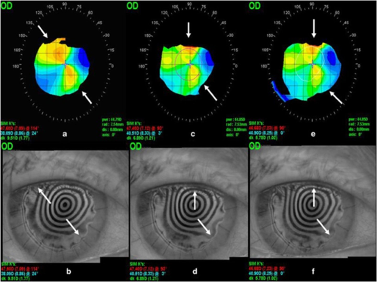 <p>If adjusting sutures does not adequately adjust astigmatism after PKP, what other techniques can we use?</p>