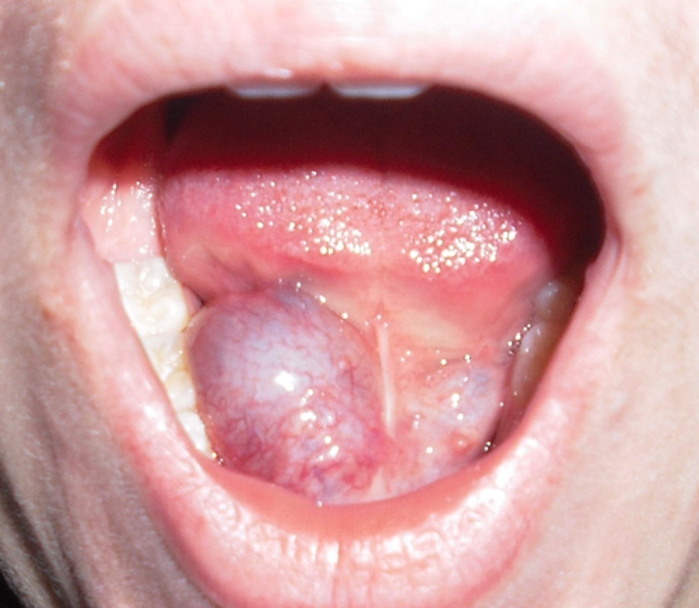 <p>Which lesion is caused by obstruction of submandibular or sublingual salivary glands?</p>