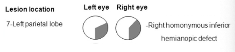 <p>parietal lobe optic radiations lesion </p><p>right homonymous inferior hemianopic defect (“pizza on the floor”) </p>