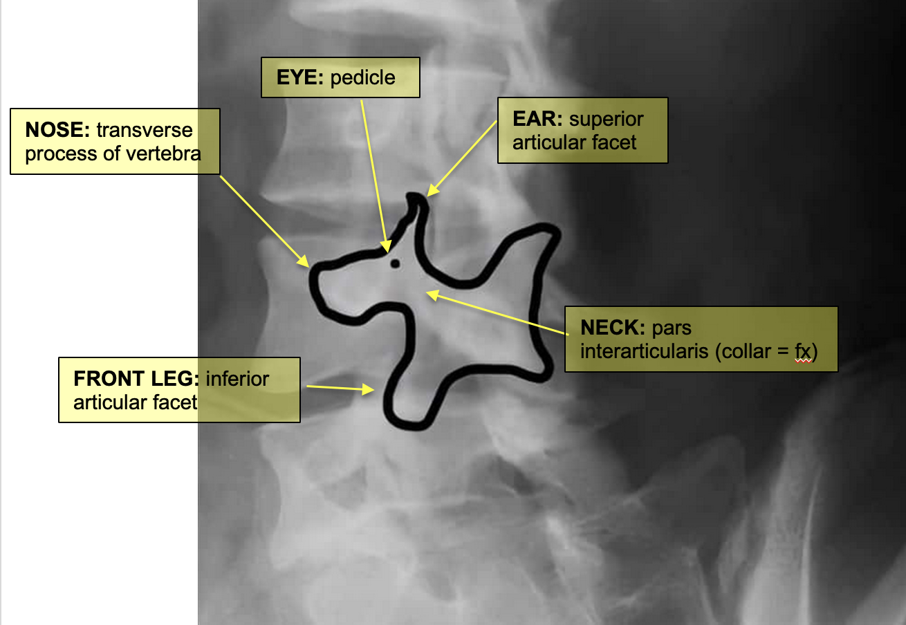 <p>ABCCP</p><ol><li><p>Alignment</p><ul><li><p>follow corners of vertebrae from one level to the next</p></li></ul></li><li><p>Bones</p><ul><li><p>Cortical outline, VB height, integrity of pedicles &amp; transverse pro.</p></li></ul></li><li><p>Cartilage</p><ul><li><p><span>IVD grad</span></p><p style="text-align: left"><span>Increase in height from sup-inf. L5/S1 narrower</span></p></li></ul></li><li><p>Coverage</p><ul><li><p>ensure entire lumbar spine is visible in each scan</p></li></ul></li><li><p>Posterior Elements</p><ul><li><p>check elements (<span>Pedicles, lamina and Pars inter</span></p><p style="text-align: left"><span>Articularis)</span></p></li></ul></li></ol><p></p>