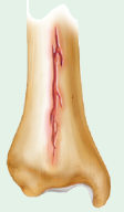 fissured fracture 