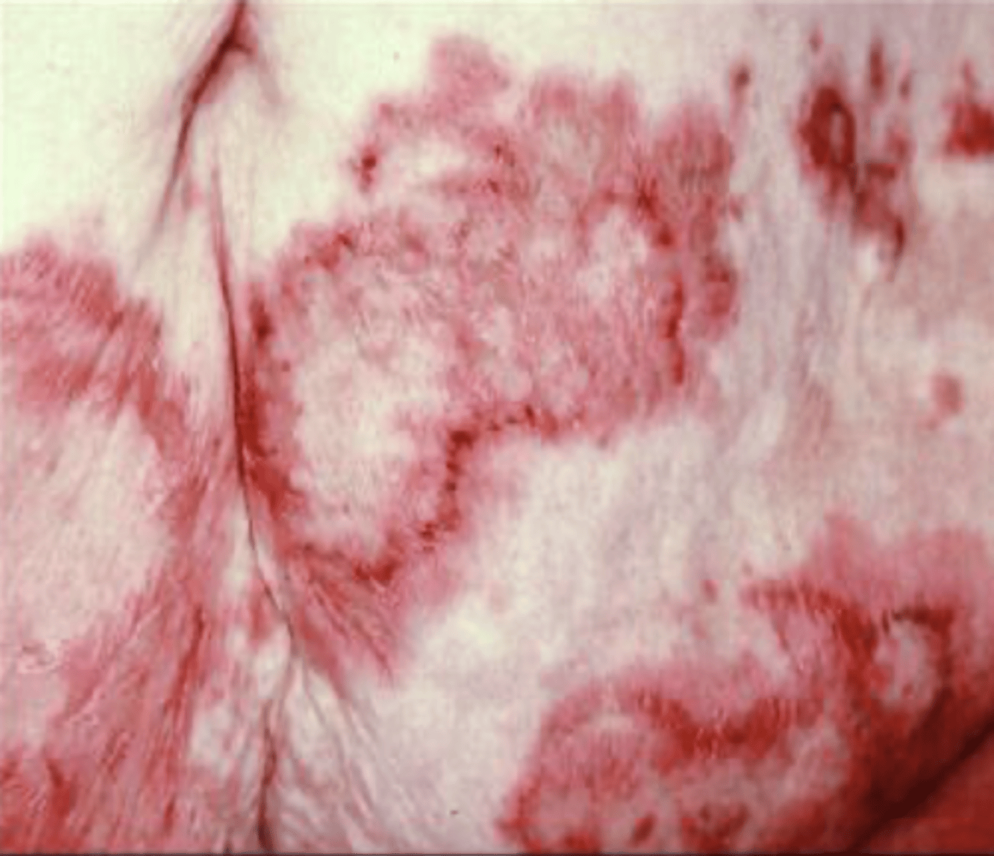 <p>6 D's</p><p>dermatitis (necrolytic migratory erythema)</p><p>diabetes</p><p>DVT</p><p>declining weight</p><p>depression</p><p>diarrhea</p>