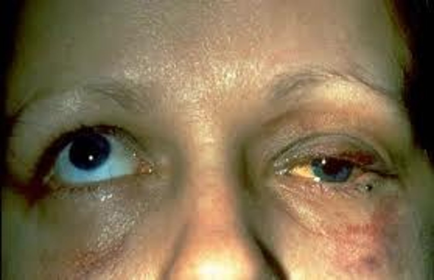<p>Clinical manifestations include diplopia (due to entrapment of inferior rectus muscle), impaired or restricted extraocular movements (EOM), pain with EOM, periorbital ecchymosis (bruising), subcutaneous orbital emphysema, enophthalmos (sunken eye), exophthalmos (bulging eye), or orbital dystopia, and facial numbness (due to damage to the trigeminal nerve's maxillary zone).</p>