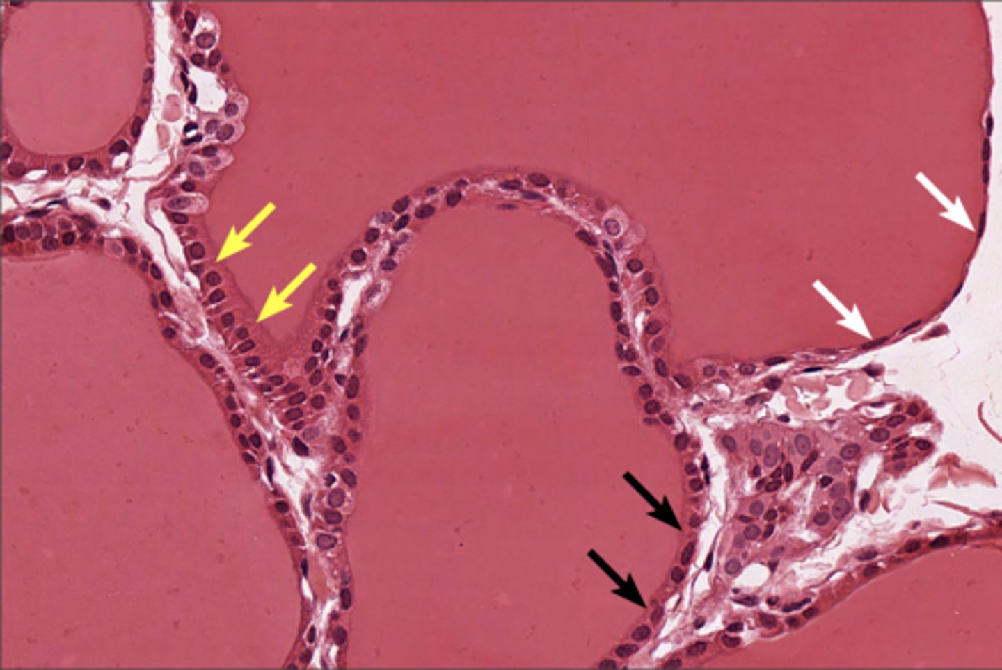 <p>In thyroid gland</p>