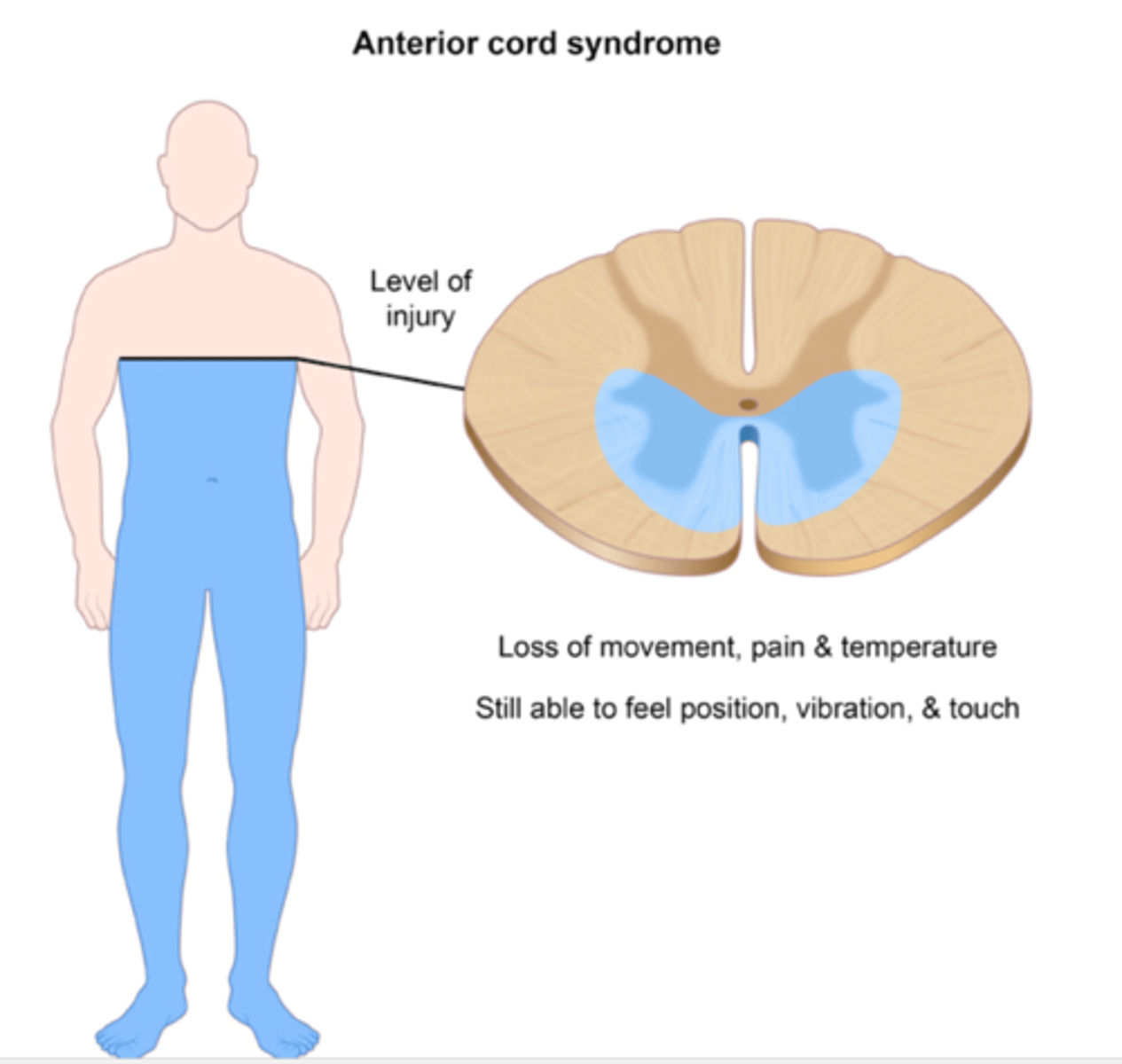 <p>Injury results in variable loss of motor function as well as pain and temperature. Proprioception is preserved.</p>