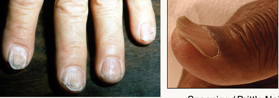 <p>what is this condition and what mineral is this person likely deficient in?</p>