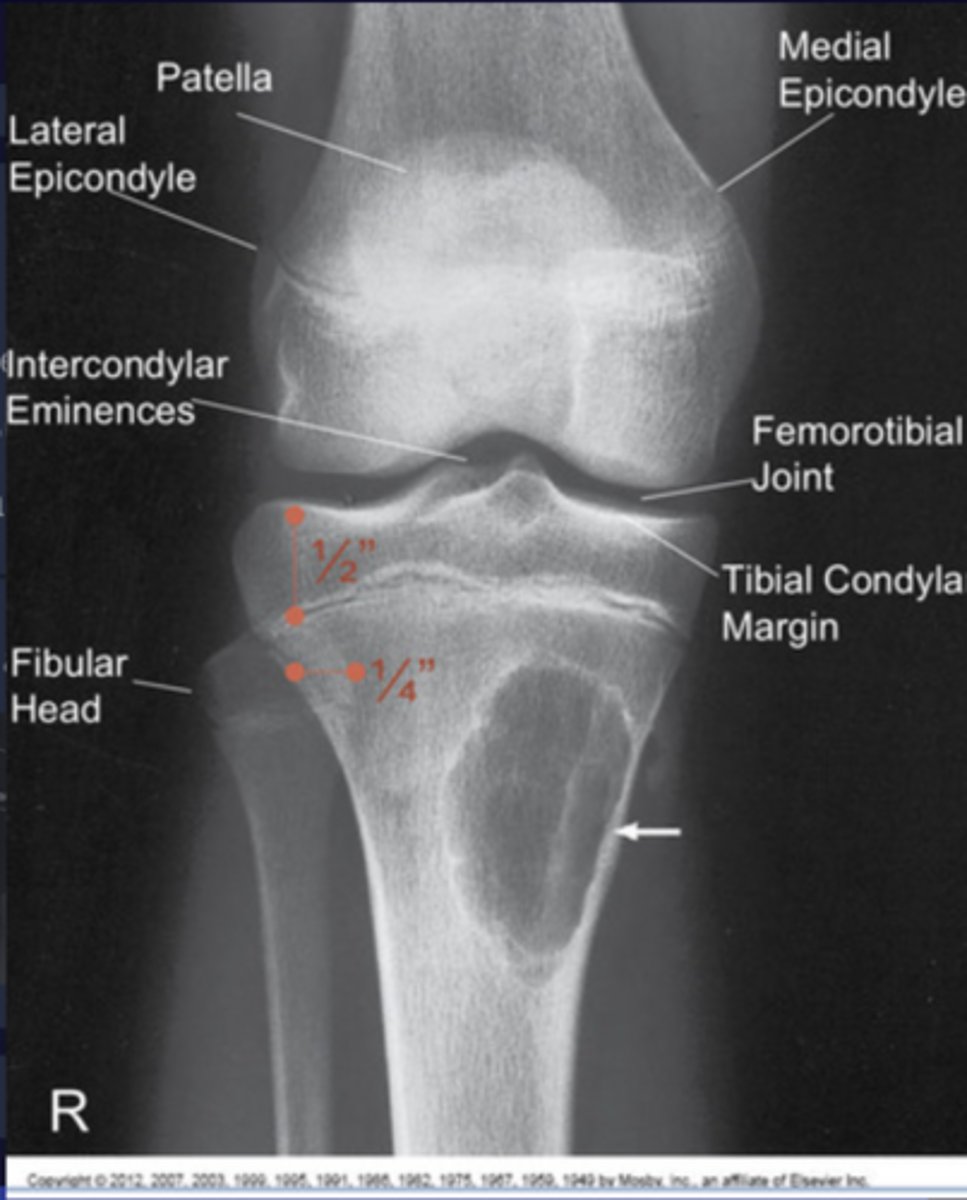 <p>Tibaia plateau 1/2" proximal to top of fibula head</p>