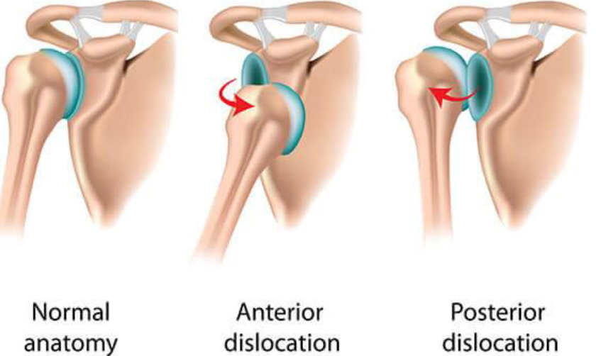 <ul><li><p>Common joint injury</p></li><li><p>Bones forced out of alignment</p></li><li><p><strong>Subluxation</strong>: partial dislocation</p></li></ul><p></p>