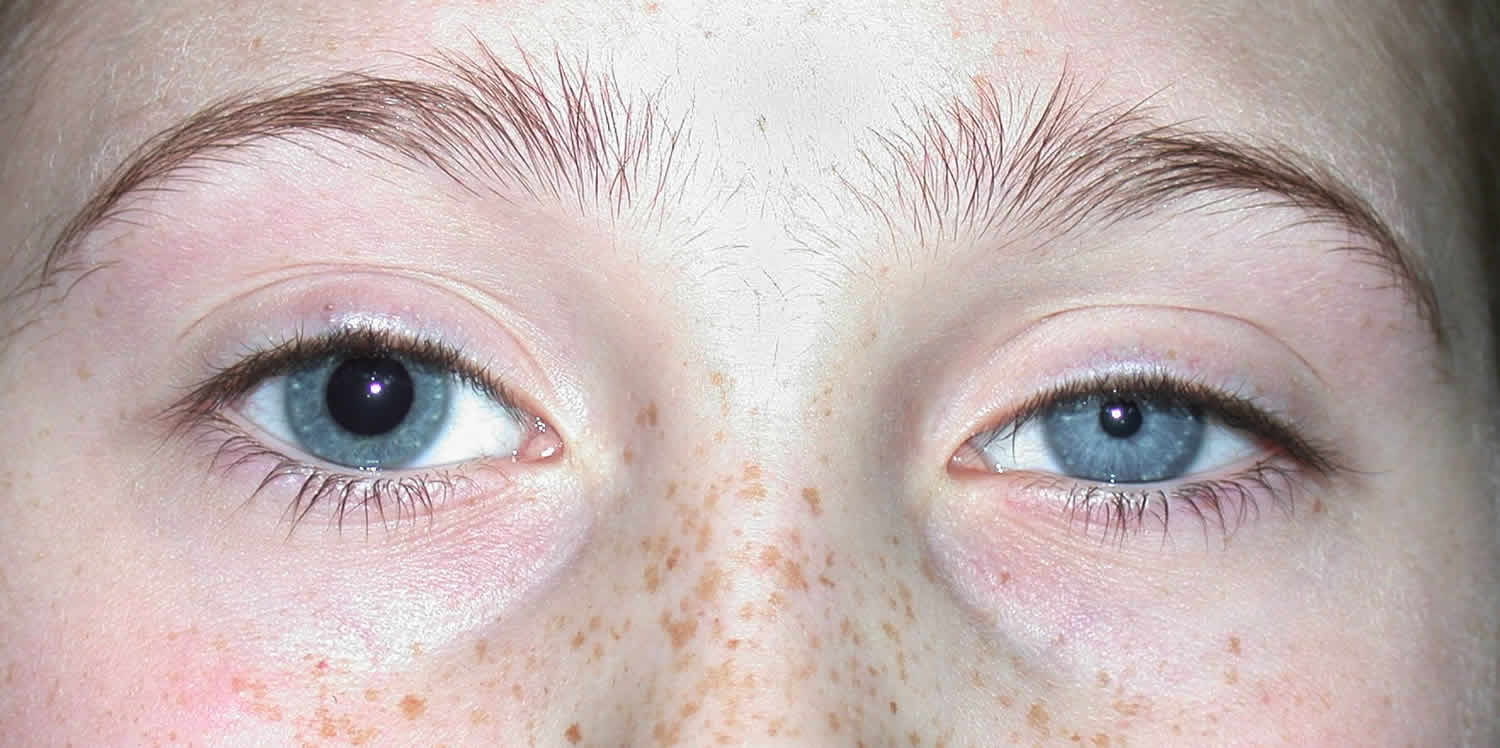 Unequal pupil sizes