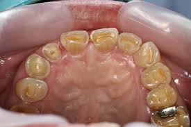 <p>PP: loss/weakening of anteiror teeth on lingual surfaces</p><p>E: recurrent regurgitation of the stomach:<br>bullimia<br>severe acid reflux</p>