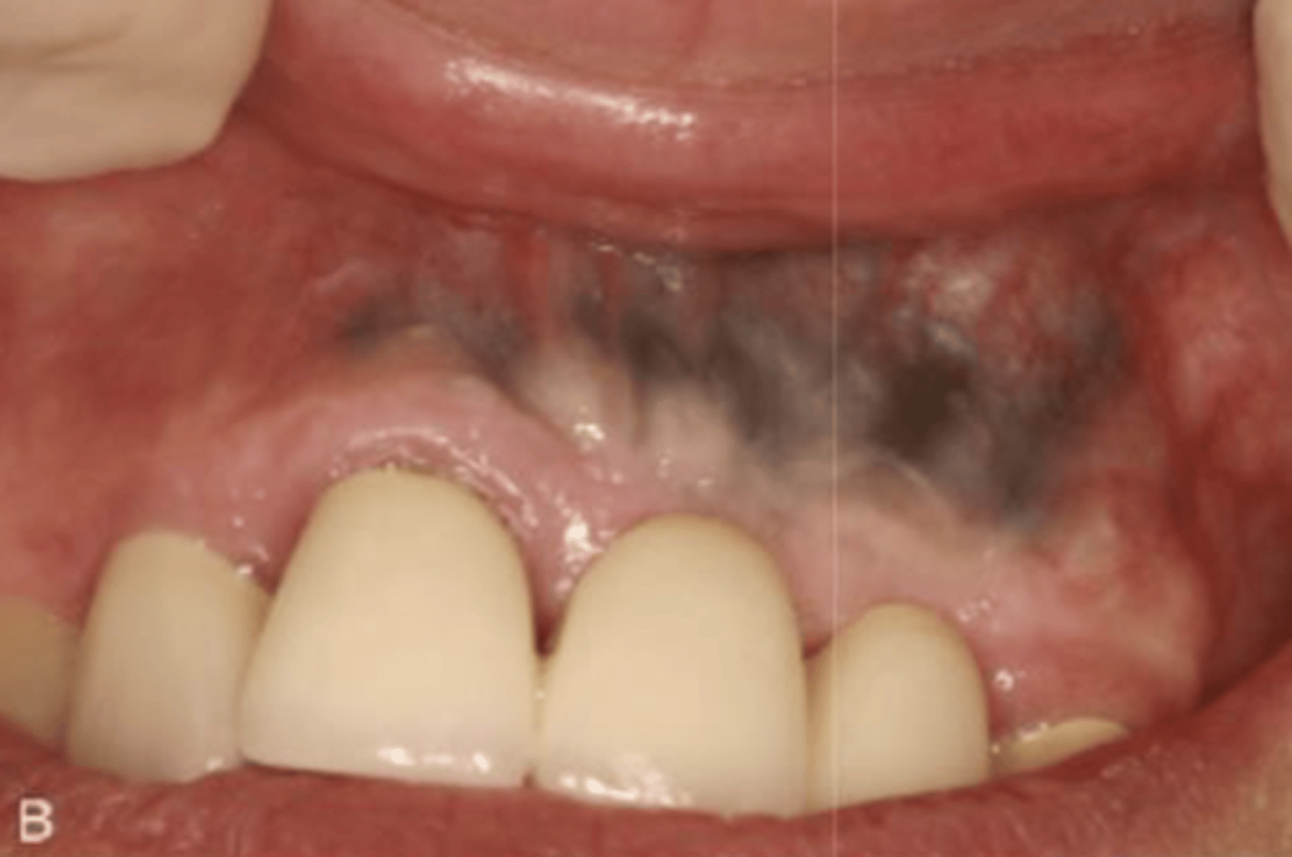 <p>What type of pigmented lesion?</p>