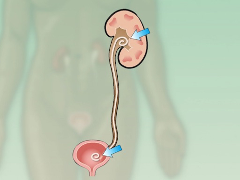 <p>Cystoscopy </p><p>Percutaneous Removal </p><p>Lithotripsy </p><p>Surgery </p><p>Ureteral Stent </p><p></p>