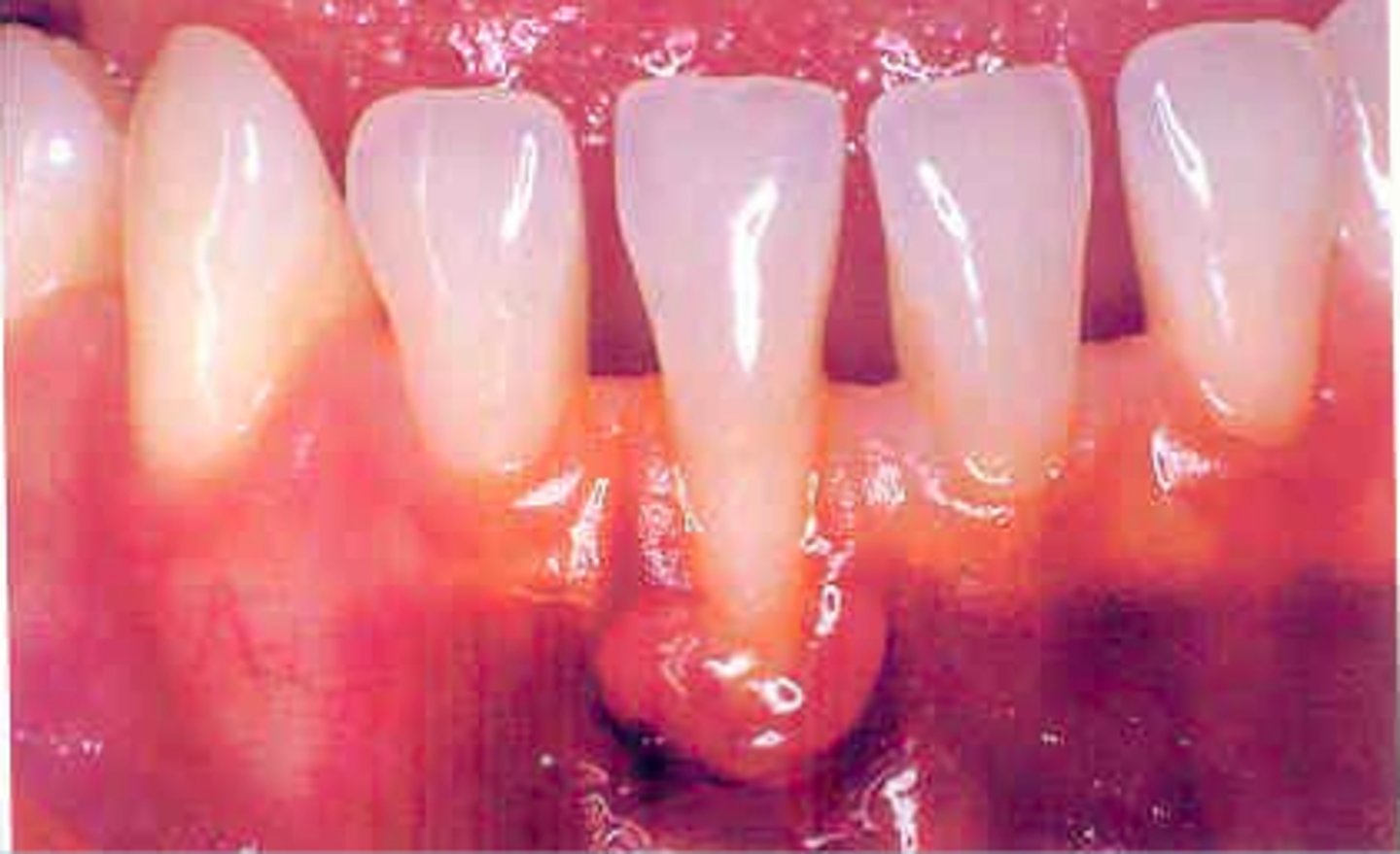 <p>innertube shaped swelling at the marginal gingiva</p>