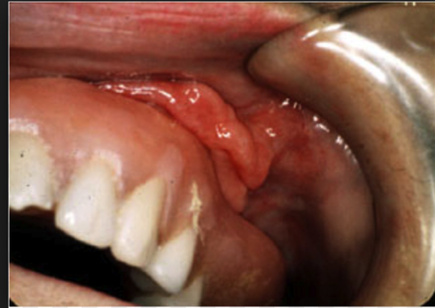 <p>Excision.</p><p>[Other answer choices: Apply tissue conditioner, leave lesion alone, prescribe antibiotics] - Epulis fissuratum - benign hyperplasia of fibrous CT that develops as a reactive lesion to chronic mechanical irritation produced by flange of poorly fitting denture</p>