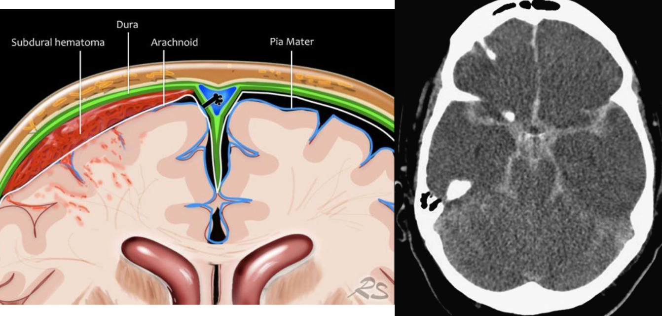 <p><span>3 </span>types depending on WHERE</p><p class="p1">blood accumulates:</p><p class="p2"><span>1.</span> Subarachnoid hemorrhage-bleeding between arachnoid</p><p class="p2">and pia.</p><p class="p2"><span>2.</span> Subdural hemorrhage-bleeding beneath dura.</p><p class="p2"><span>3. </span>Epidural hemorrhage-bleeding between dura and skull.</p><p class="p2">● TBI usual cause of subdural and epidural hemorrhages</p><p class="p2">● After bleeding stops, left with a hematoma</p><p class="p2">(subarachnoid, subdural, or epidural)--accumulation of</p><p class="p2">clotted or partially clotted blood in the space created</p><p class="p2">by the hemorrhage</p>