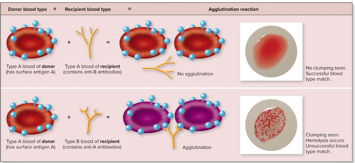 <p>type <strong>A </strong>blood <strong>clumps </strong>due to<strong> anti-A antibodies</strong> from type <strong>B </strong>blood</p>