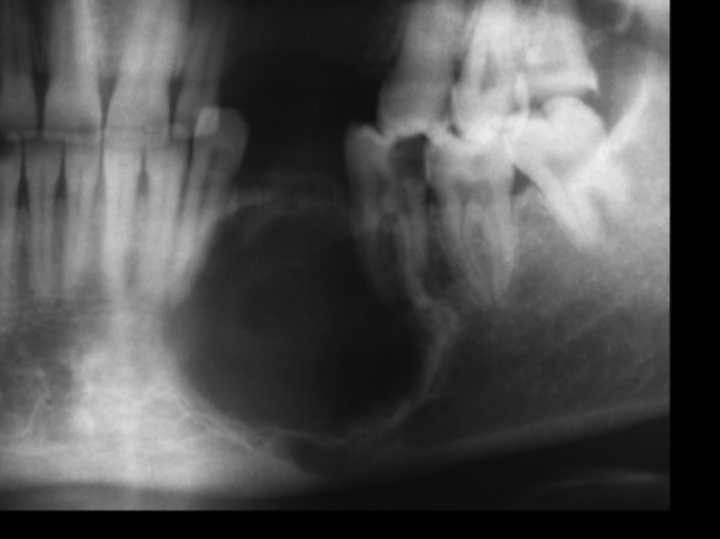 <p>Well circumscibed radiolucency with or without radiopacities</p><p>- Has sclerotic border</p><p>- Grows slowly</p><p>-Txt: scoop out</p>