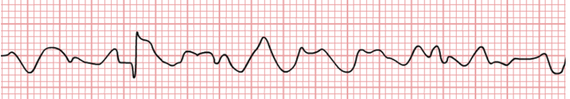 <p>VENTRICULAR FIBRILLATION nursing action</p>