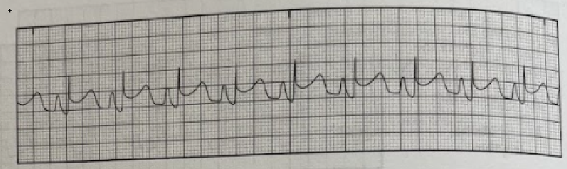 <p>Which of the following is shown on the EKG tracing?</p><p>A. Heart block</p><p>B. Myocardial infarction</p><p>C. Ventricular fibrillation</p><p>D. Atrial flutter</p>