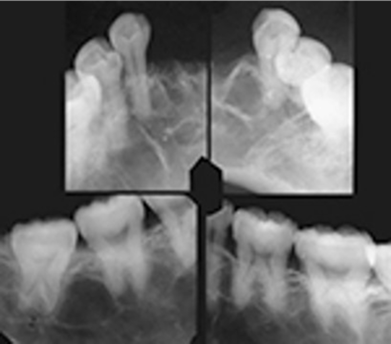 <p>a genetic disorder in which erythroctyes take on an abnormal curved or "sickle" shape</p>
