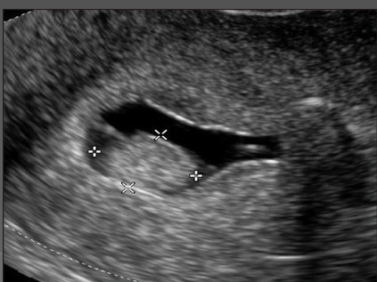 <p>In premenopausal women, sonohysterography is performed in the _________ cycle, usually between days ___ and _____</p>