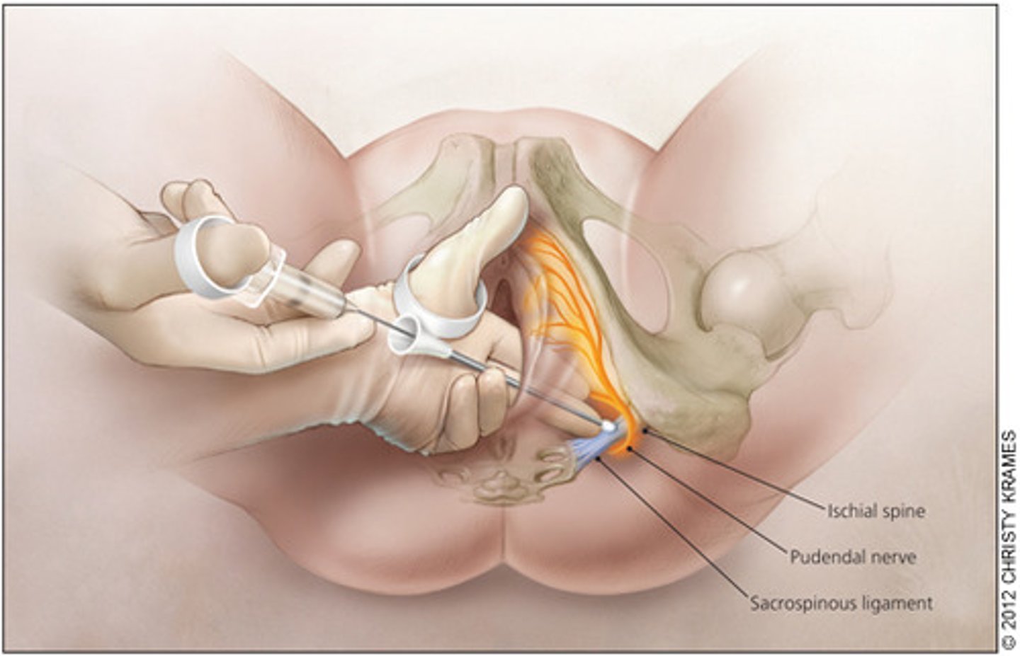 <p>Damage to the Pudendal nerve (Lumbo-Sacral) (Paws)</p>