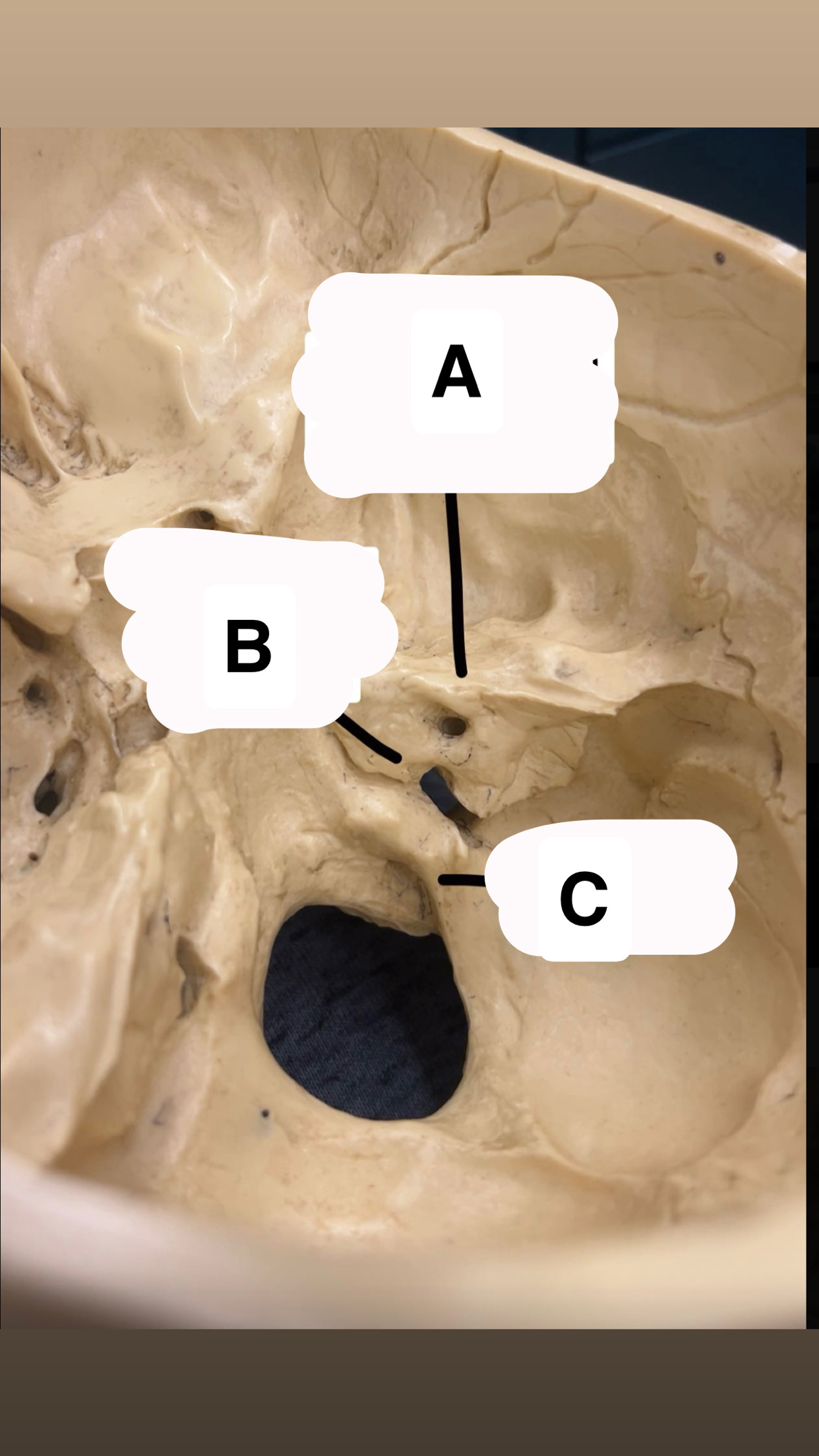 <p>What is “A” and what cranial nerve(s) pass through it?</p>