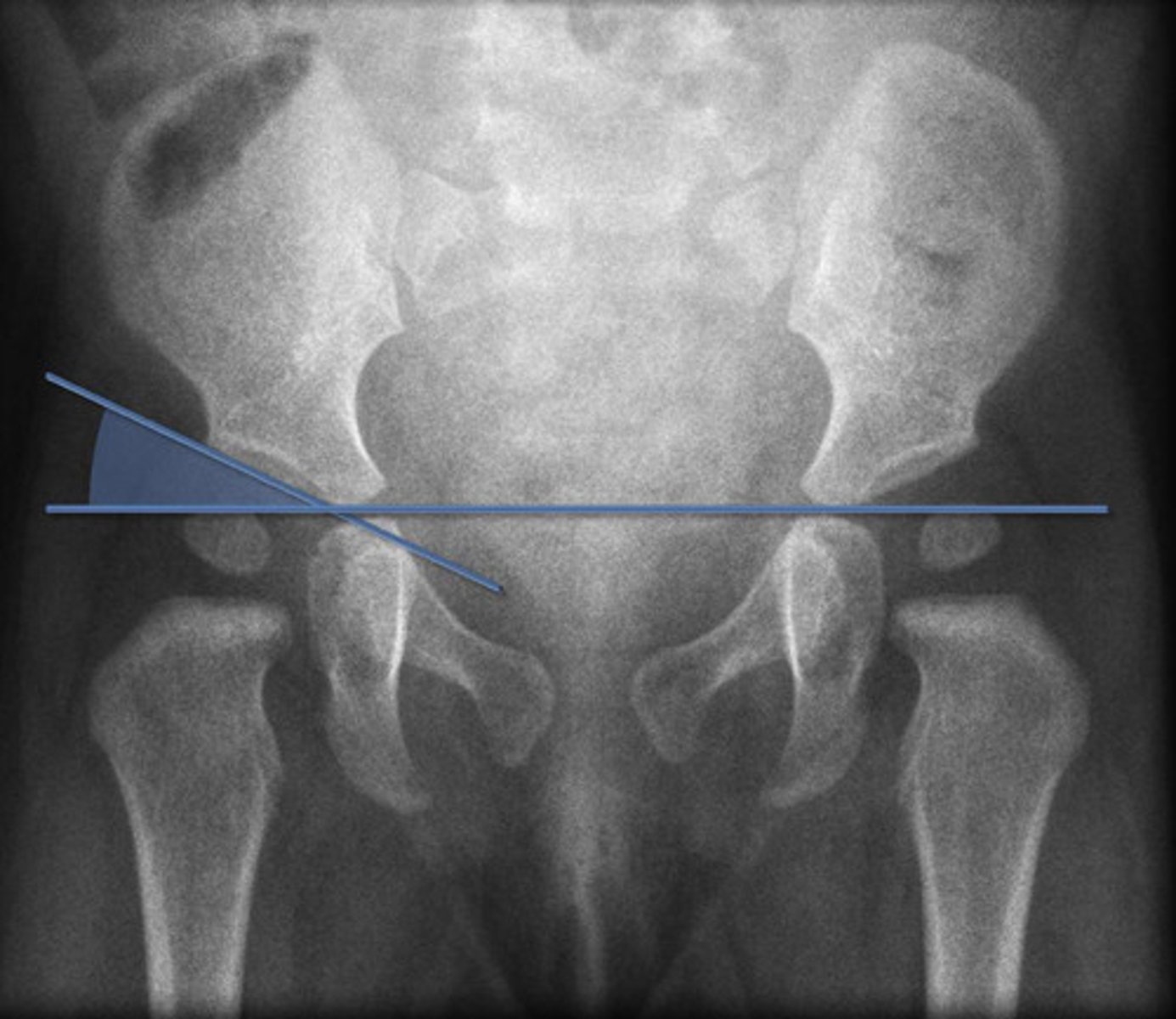 <p>Angle measured between Hilgenreiner's line and a line parallel to the acetabular roof</p>