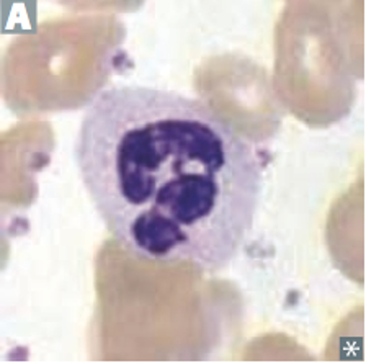 <p>Auto-recessive <br>-absence of MPO, but neuts can use alternative routes to kill so no increase in infection</p>