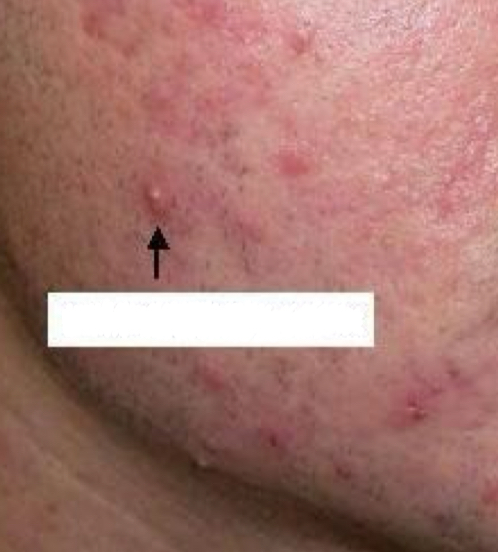 <p>what type of lesion is depicted</p>