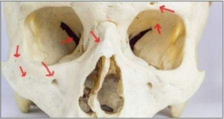 <p>an opening or hole in tissue, usually a bone. allows blood vessels or nerves to travel from one side of tissue layer to another</p>