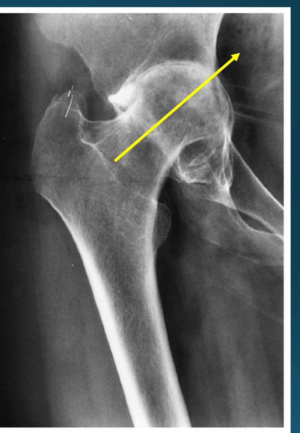 <p>RA impact on hip can cause what </p>