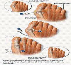 <p><span style="font-family: Lato Extended, Lato, Helvetica Neue, Helvetica, Arial, sans-serif">This picture shows hammer toe.</span></p>