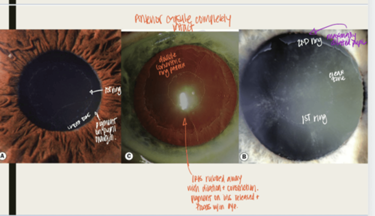 <p>What is the pathogenesis of pseudoexfoliation?</p>